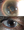 Figure. Complex cataract surgery with retained lens material, aphakia, and iris damage (A), followed by pars plana lensectomy and vitrectomy, secondary lens implantation, and iris repair by a single VR surgeon; the patient achieved a visual acuity of 20/20 (B).