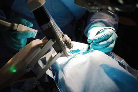 Robotic Cataract Surgery