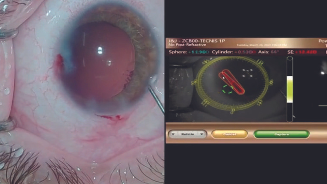 IOL Exchange in an Eye With Silicone Oil