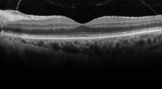 Evaluating the Retina Before Cataract Surgery