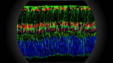 Johns Hopkins Researchers Explore Why Episodes of Low Blood Sugar Worsen Eye Disease in People with Diabetes image
