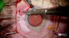 Repositioning a Dislocated Multifocal IOL With the Yamane Technique thumbnail