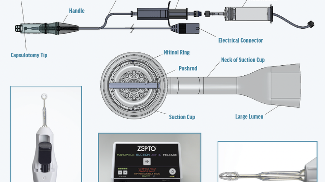 Continuing Excellence in Capsulotomy Innovation with Zepto