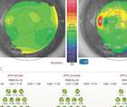 Monocular Diplopia Foggy Vision and Uncomfortable Binocular Vision