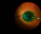 Guidance on Repairing a Macular Hole thumbnail