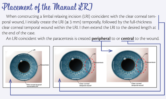 Why All Cataract Surgeons Should Know How to Perform a...