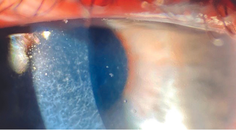 A Decrease in Quality and Quantity of Vision