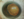 Figure 1. The left eye has a cataract and exhibits temporal subluxation of the crystalline lens.