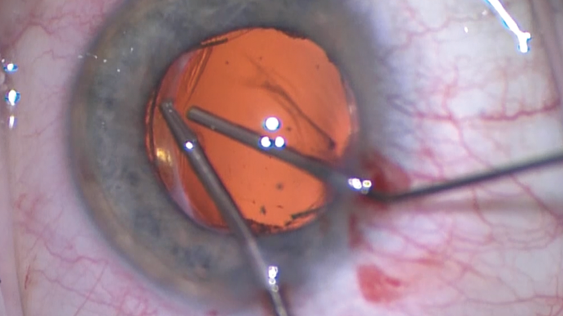 Postoperative Intolerance of Monovision