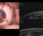 Intraoperative OCT for Corneal Cyst Removal thumbnail
