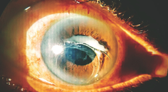 Late Spontaneous Dislocation of the IOLCapsular Bag Complex in a Patient With Retinitis Pigmentosa