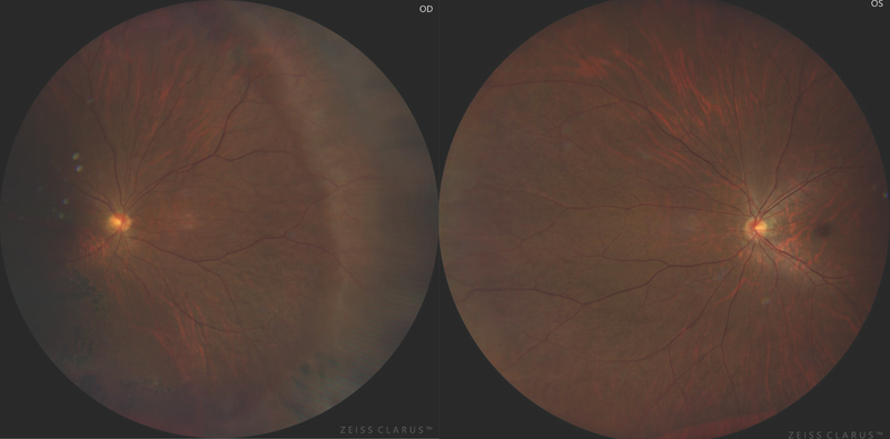 Cataract Surgery in Eyes With Retinal Pathology